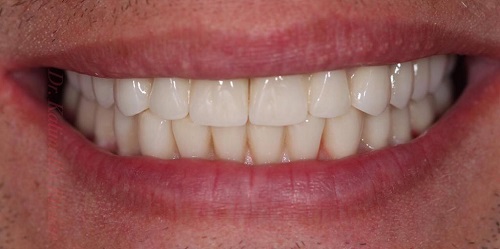 Зубы мужчина4