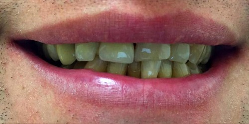 Зубы мужчина3