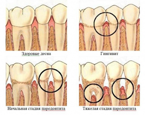 Лечение зубной слизистой 