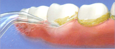 Удаление зубного налёта