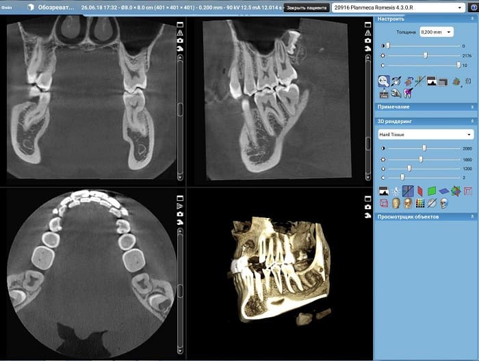 Компьютерная томография зубов цены