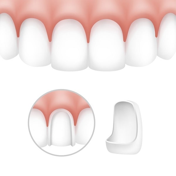 Что такое виниры для зубов и как они крепятся на зубы?