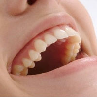 Бюгельный протез зубов