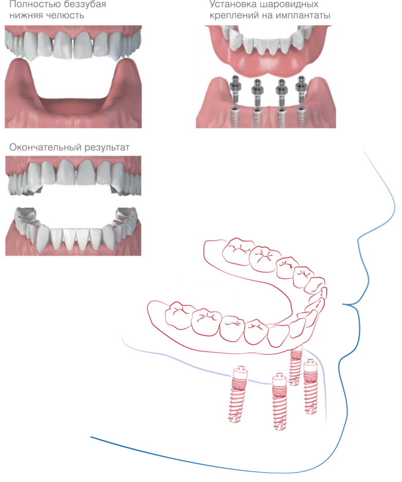 Восстановление трех зубов