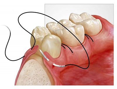 Цистэктомия зубов