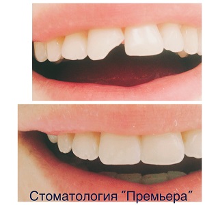 Наращивание зубов Томск Некрасова Чистка зубов Томск Болотный